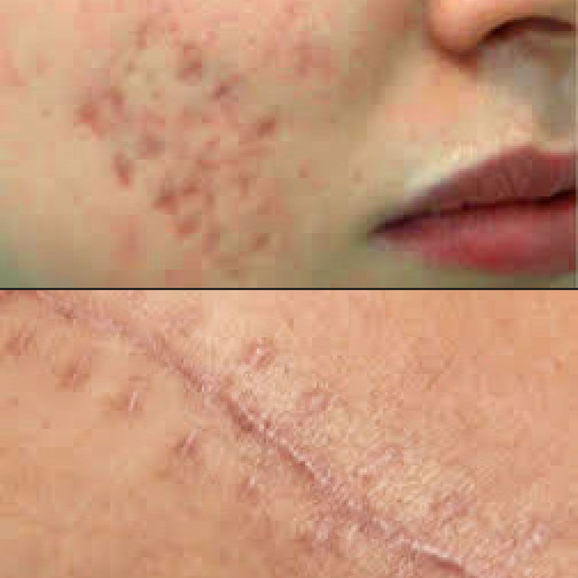 Cicatrices d'acné ou chirurgicales sont traitées avec le laser Secret Pro.Florence MAGAND-NOWAK Dermatologue-Annecy 74