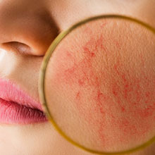 Laser dernière génération EXCEL V de Cutera pour traiter rougeurs, angiomes, couperose, erythrose. Florence MAGAND-NOWAK Dermatologue-Annecy 74