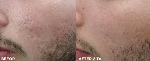 Traitement des cicatrices d'acné et chirurgicales. Florence MAGAND-NOWAK Dermatologue-Annecy 74