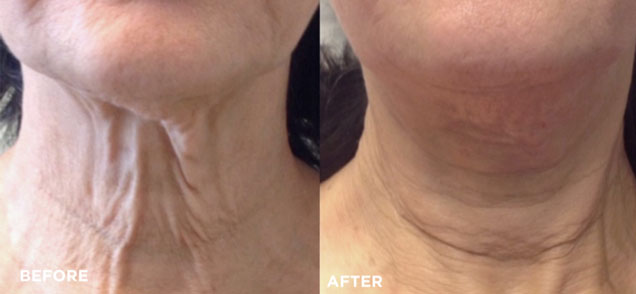 Traitement du relâchement de la peau. Florence MAGAND-NOWAK Dermatologue-Annecy 74