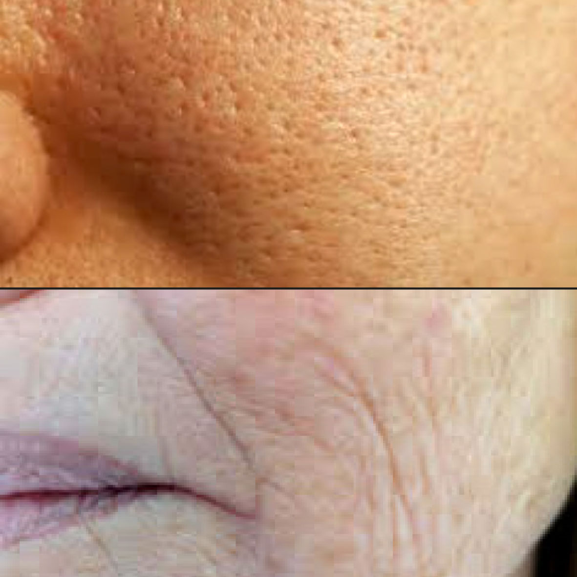 Pores dilaté et rides sont traités avec le laser Secret Pro.Florence MAGAND-NOWAK Dermatologue-Annecy 74