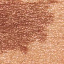 Florence MAGAND-NOWAK Dermatologue-Annecy 74
